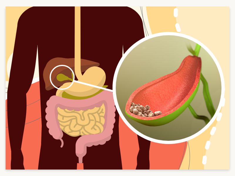 Unusual Symptoms of Gallbladder Disease