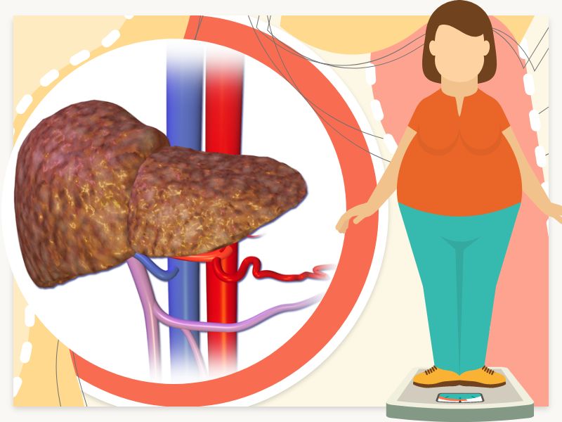 How Serious Is Fatty Liver Disease?