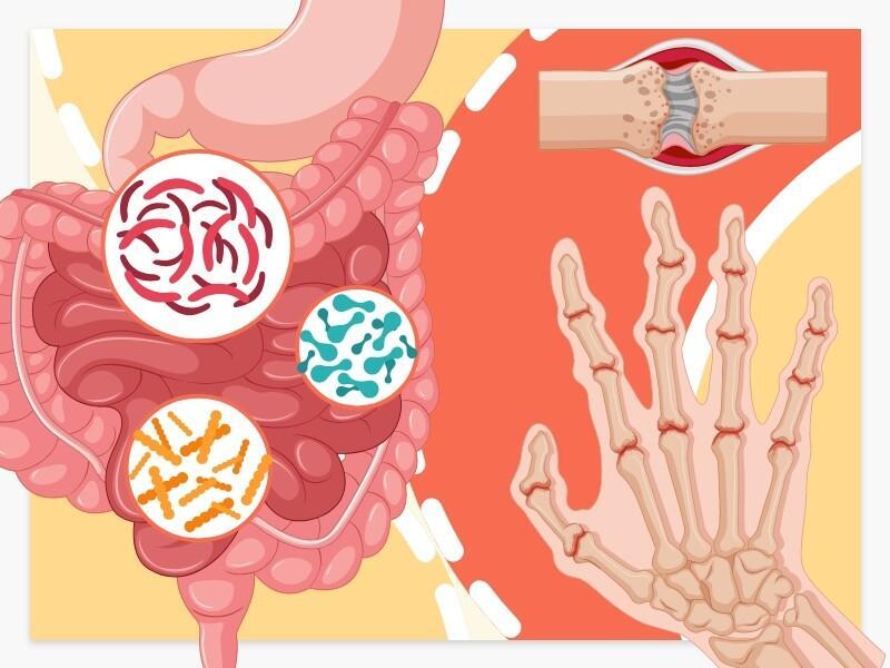 Can Probiotics Treat Rheumatoid Arthritis?